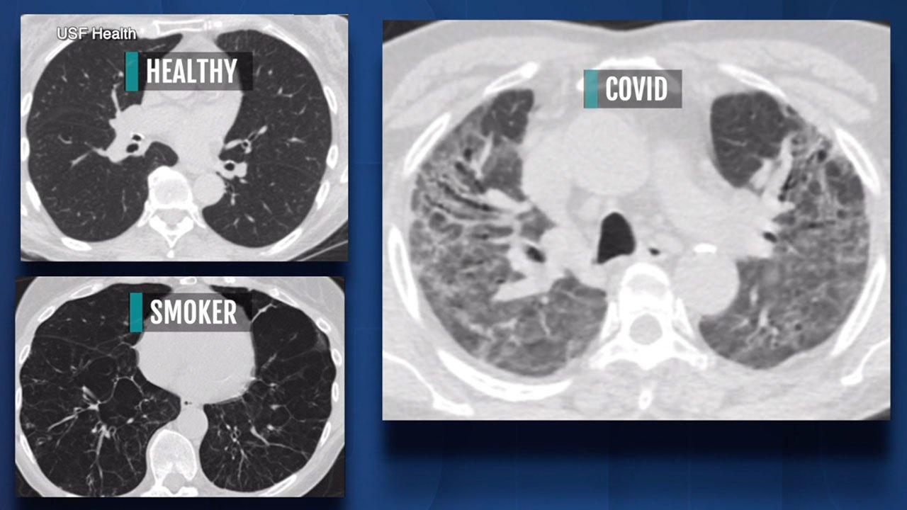 Lung scans show COVID-19 can leave severe damage, even in those who didn’t have symptoms