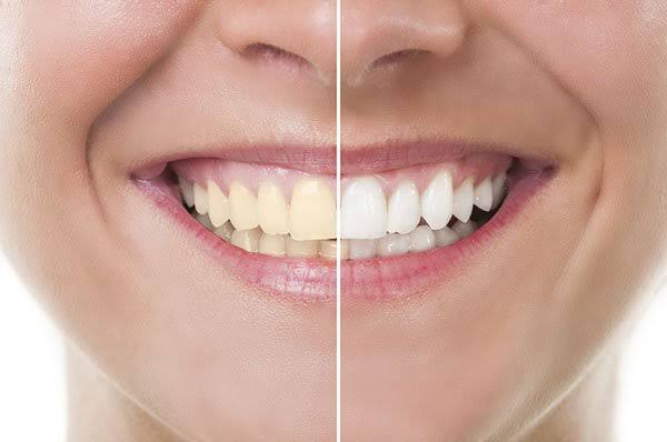Got yellow teeth? effective natural ways to whiten teeth