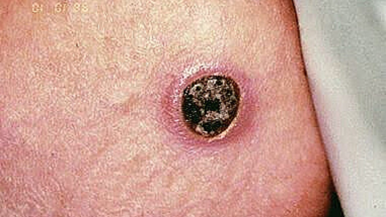 After black, white & yellow fungus, another fungal infection Nasal Aspergillosis on rise After black, white & yellow fungus, another fungal infection Nasal Aspergillosis on rise