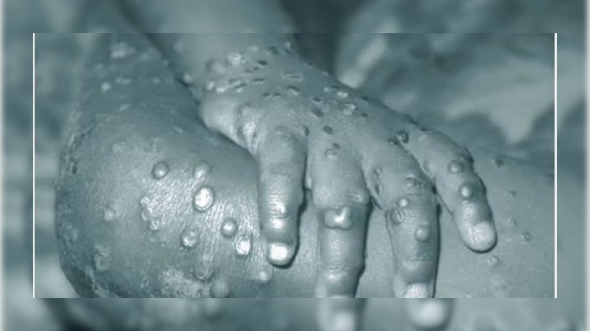India reports first Monkeypox casuality