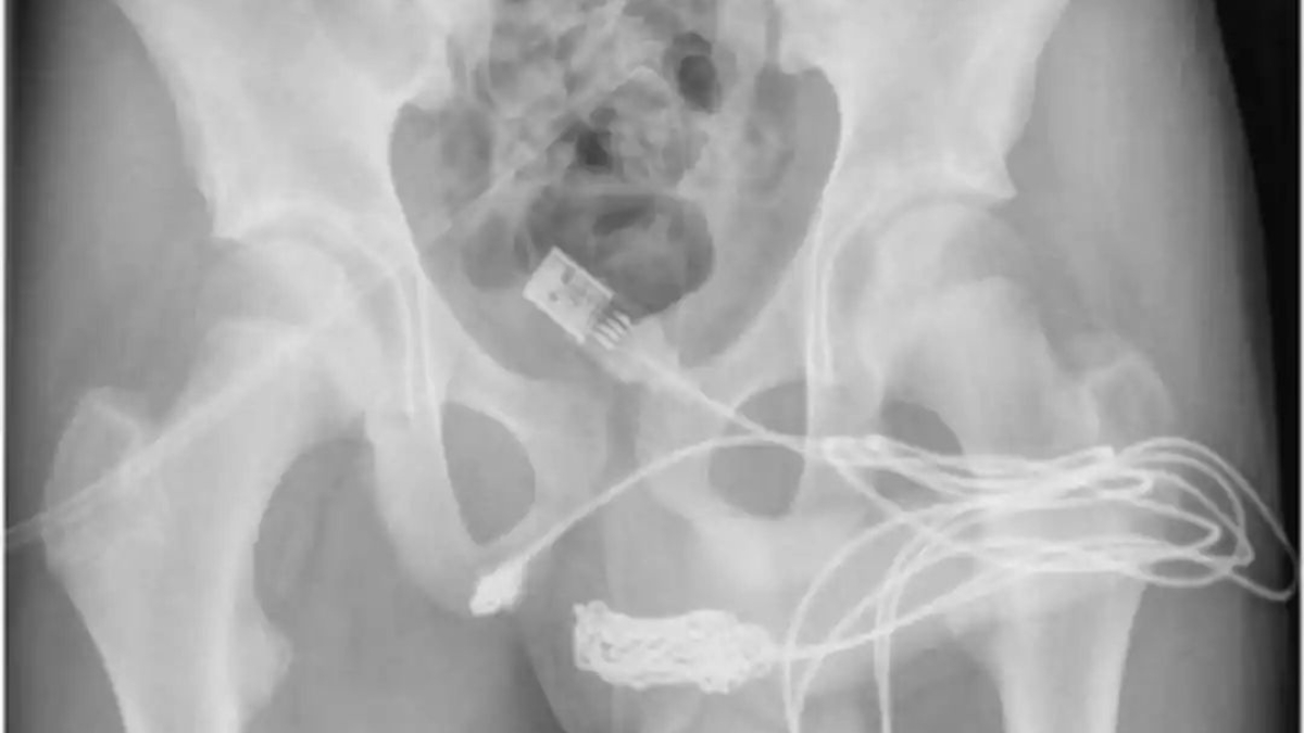 Teenager undergoes surgery to get USB cable removed from Penis Teenager undergoes surgery to get USB cable removed from Penis