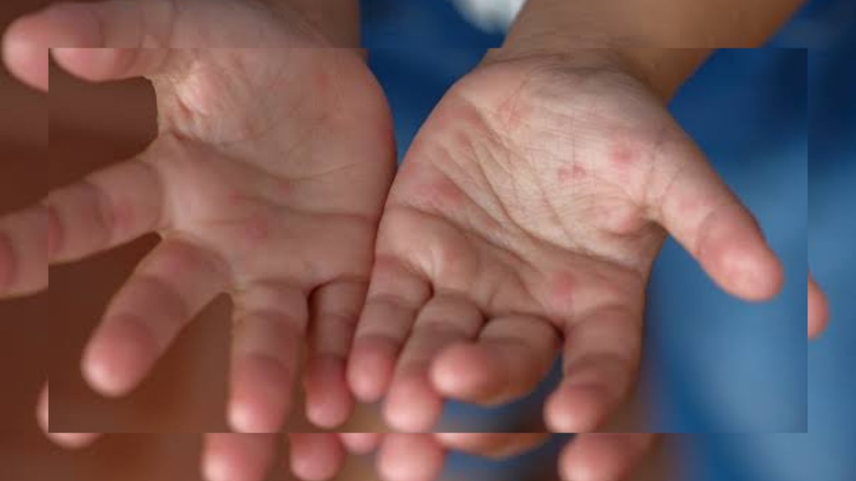 Hand, foot and mouth disease outbreaks at Mallinson Girls School, Sgr