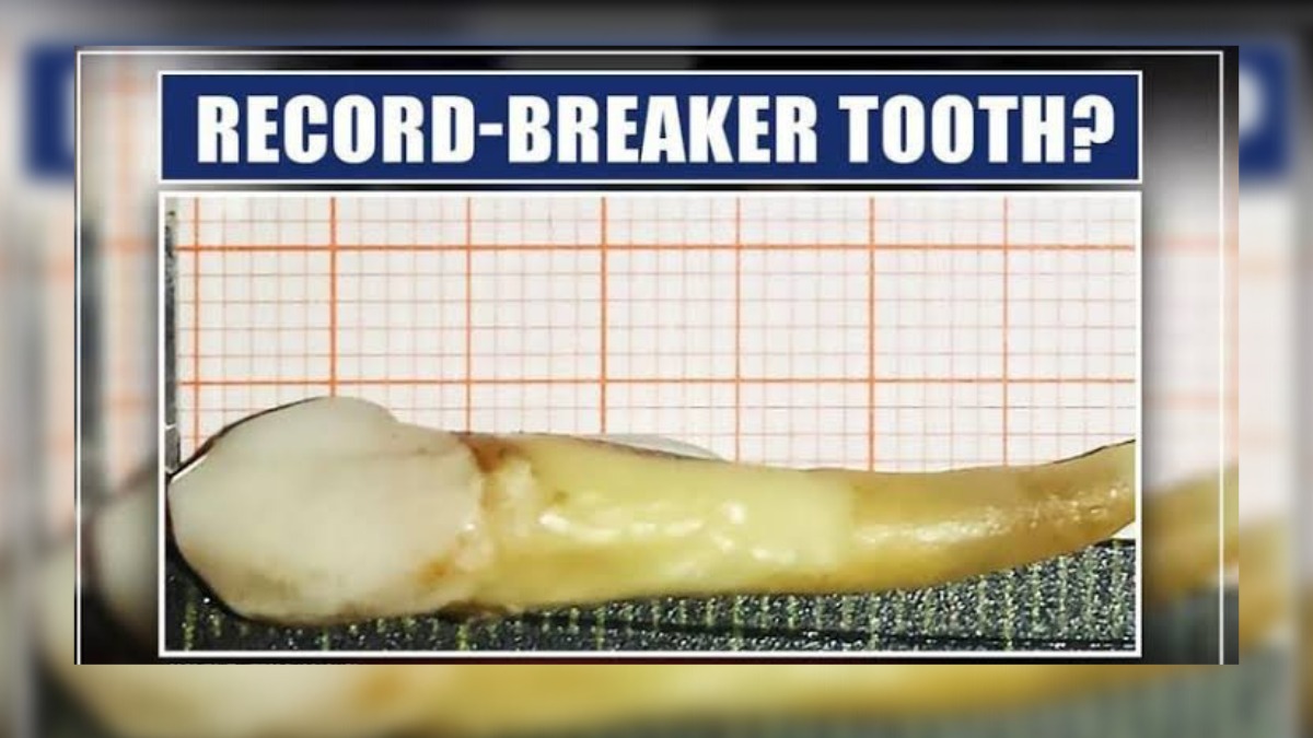 Doctors extract world’s ‘longest’  tooth at SDH Beerwah, Budgam