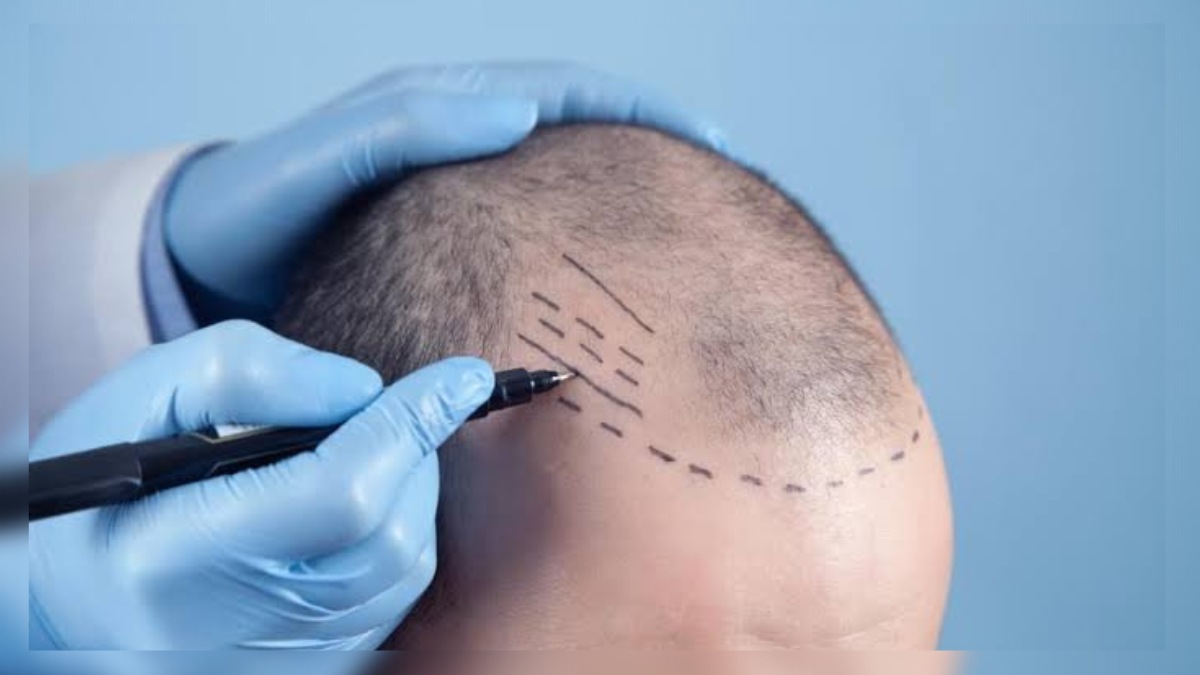 Man dies painful death after hair transplant goes wrong