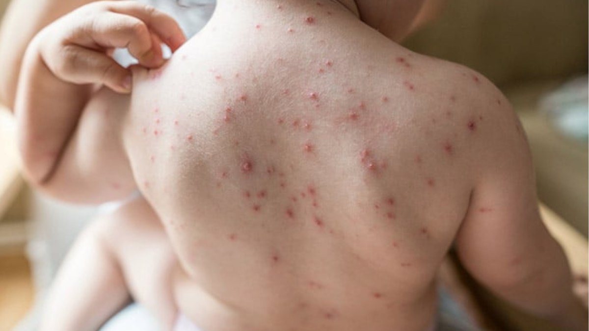 Chicken pox case reported in Kupwara’s Langate