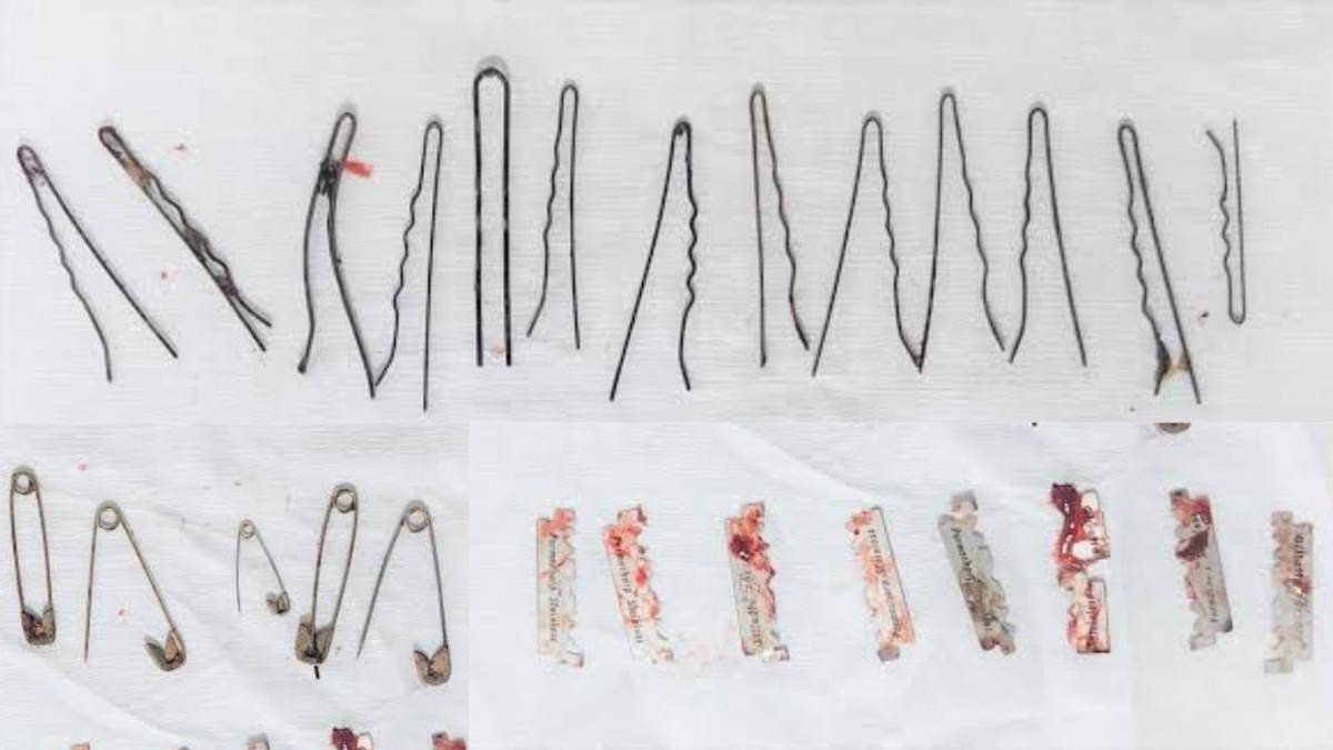 Doctors remove 13 hairpins, 5 safety pins, 5 razor blades from man’s stomach