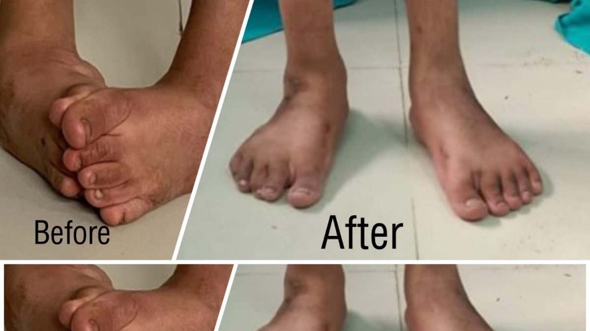 Ilizarov technique at B&J hospital Srinagar transformes lives