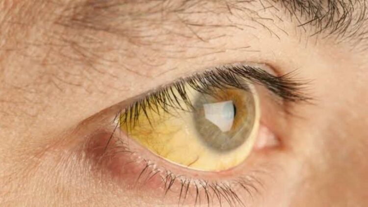 27 Test Positive for Jaundice in Anantnag 27 Test Positive for Jaundice in Anantnag