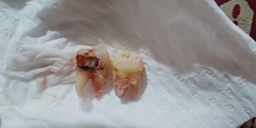 Dental College Srinagar Doctor Suspended Over Negligence; Inquiry Ordered