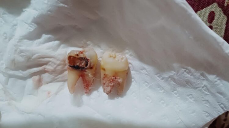 Dental College Srinagar Doctor Suspended Over Negligence; Inquiry Ordered Dental College Srinagar Doctor Suspended Over Negligence; Inquiry Ordered